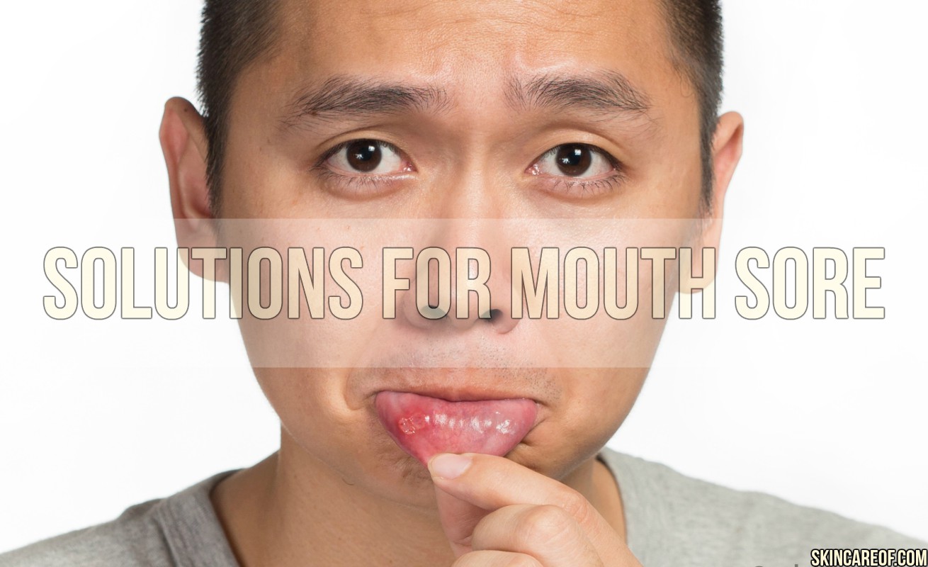 Best Herbal And Natural Solutions For Mouth Sore