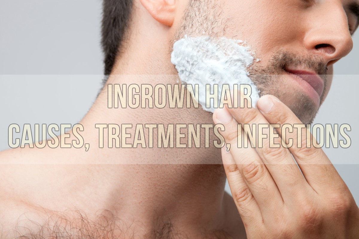 Ingrown Hair Causes, Treatments, Infections